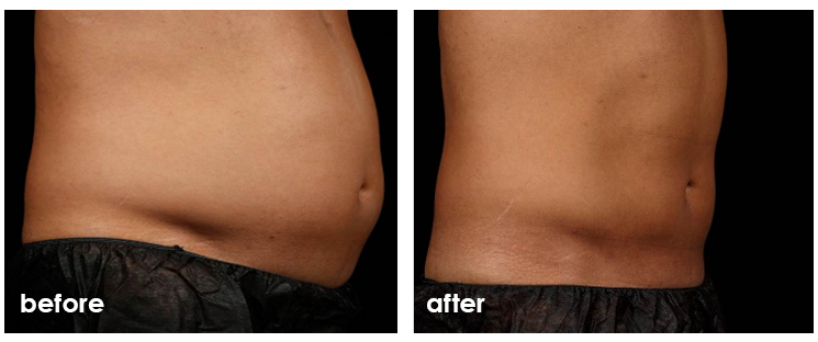 ba_sculpsure-2