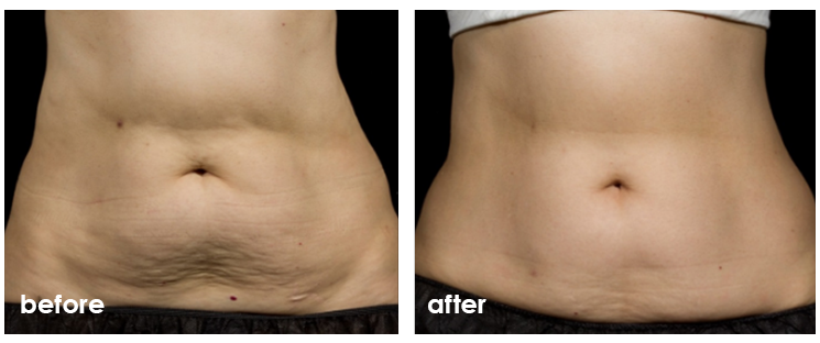 ba_sculpsure-3